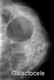 ¿Que significa BIRADS en la mamografía?